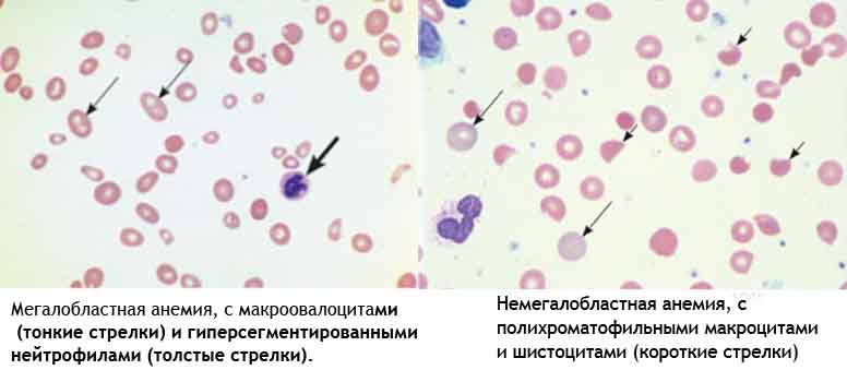макроцитарная анемия